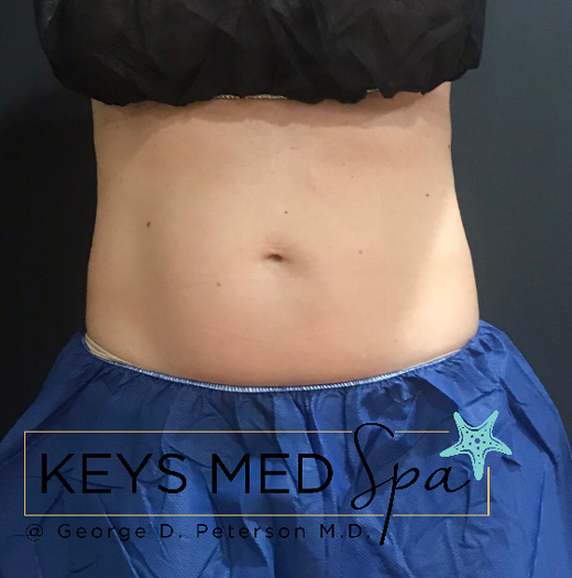 female patient's flanks before coolsculpting