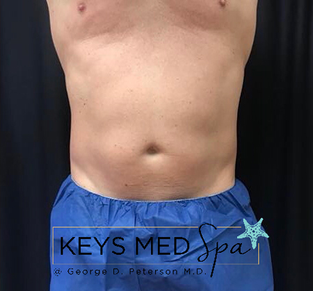 abdominal area after CoolSculpting