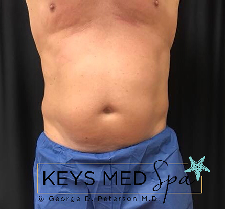 abdominal area before CoolSculpting