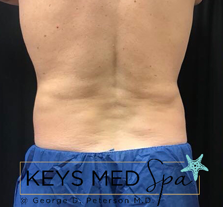 male patient's flanks after coolsculpting