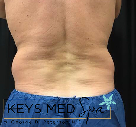 male patient's flanks before coolsculpting