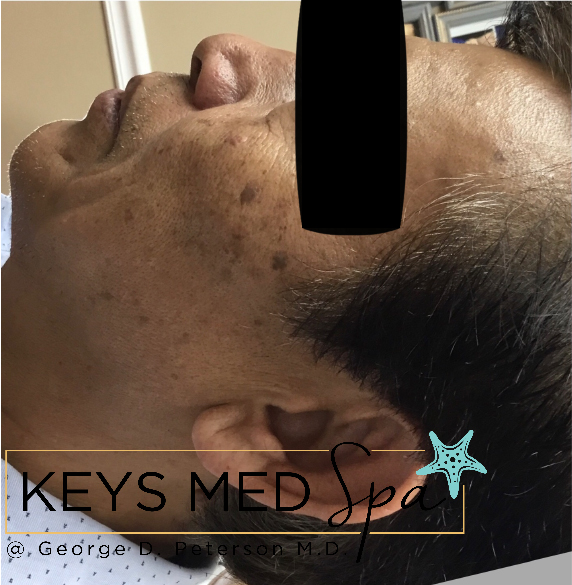 age spots on male patient