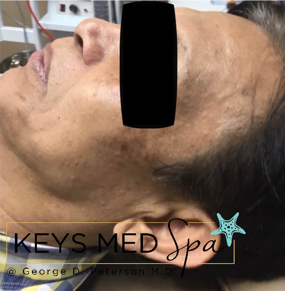 lighter age spots after IPL on male patient