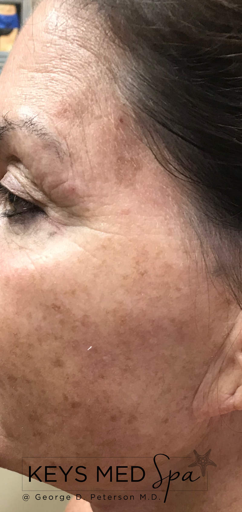 before intense pulsed light treatment on cheeks