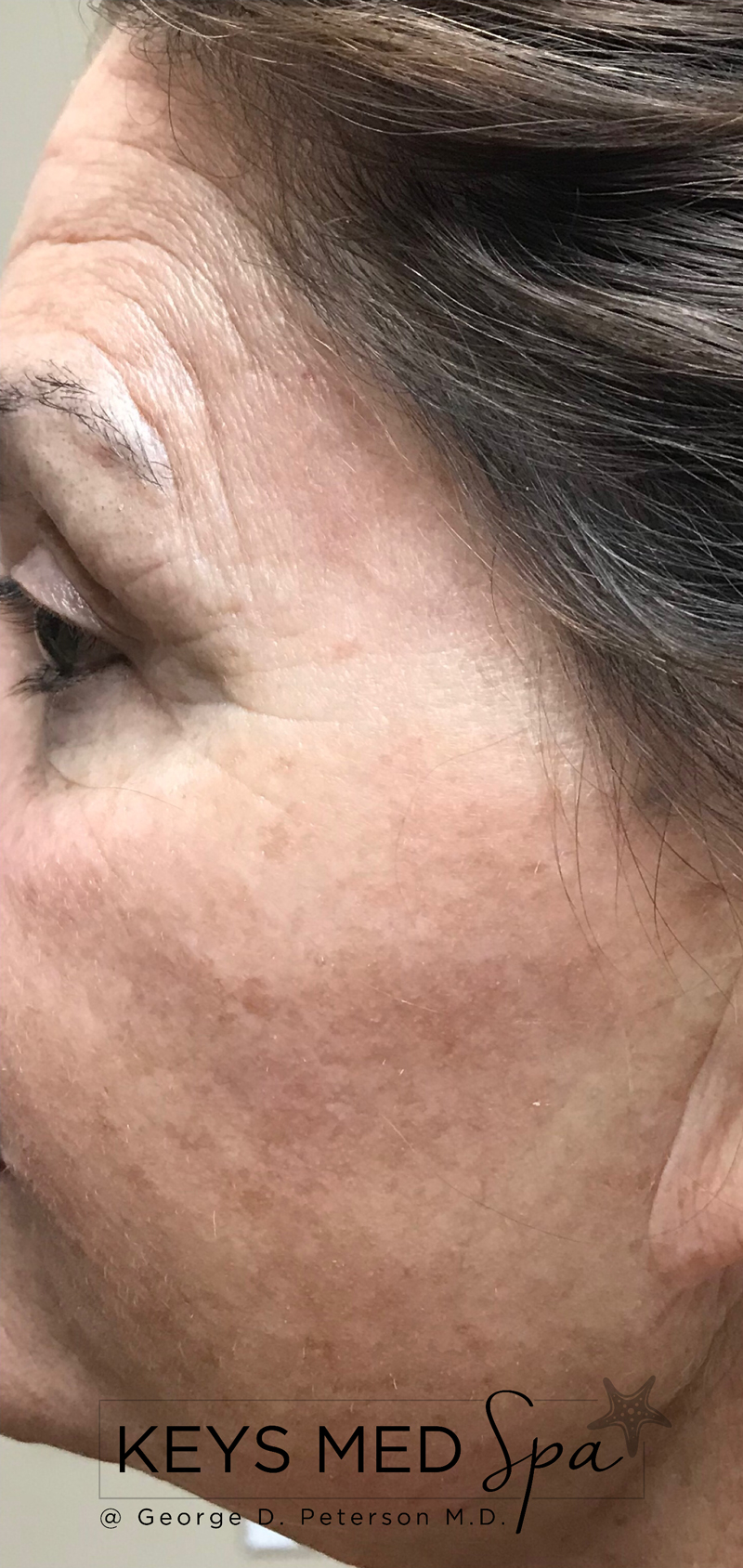 after intense pulsed light treatment on cheeks