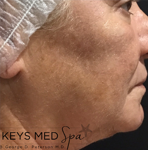 cheeks before IPL Lumecca treatment