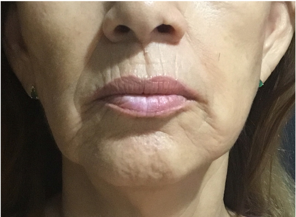 after microneedling