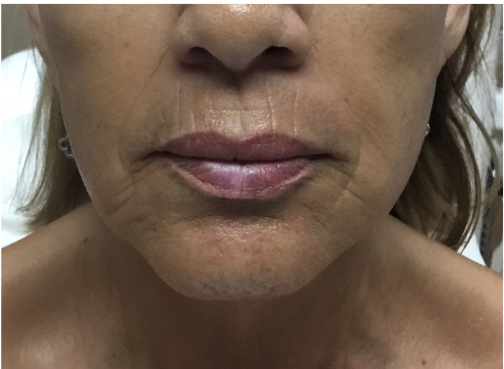 before microneedling