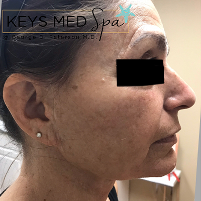 before microneedling