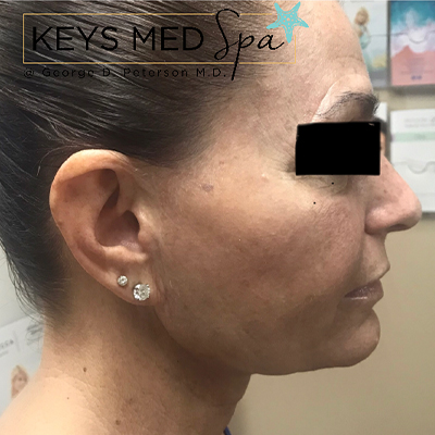 after microneedling