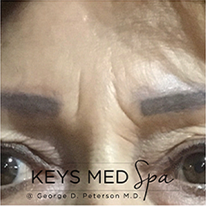 wrinkles before microneedling