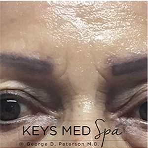 smoother glabella after microneedling